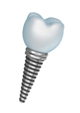 dental implants